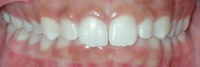 Orthodontics, Braces Deep Bite Before Photo